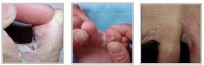 怎么拯救你,我的“大汗脚”……脚臭和脚气,有多远的距离?