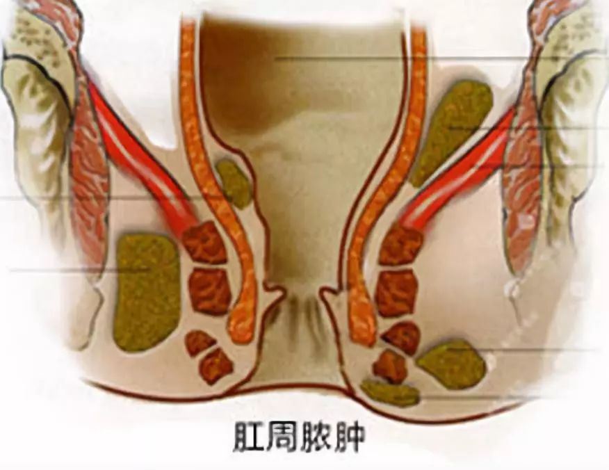 你该了解的肛周脓肿,深度了解肛周脓肿