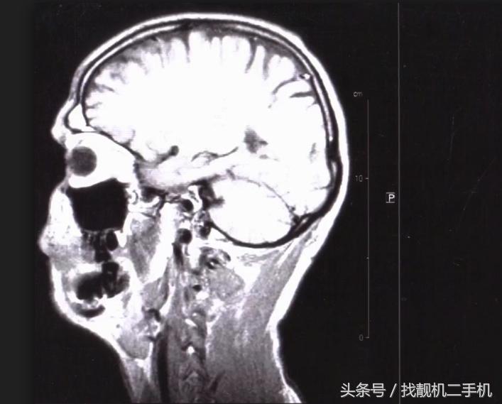 手上粘上汞怎么处理,汞粘在手上能洗掉吗