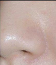 治疗毛孔粗大的护肤品,烟酰胺可以治疗毛孔粗大吗