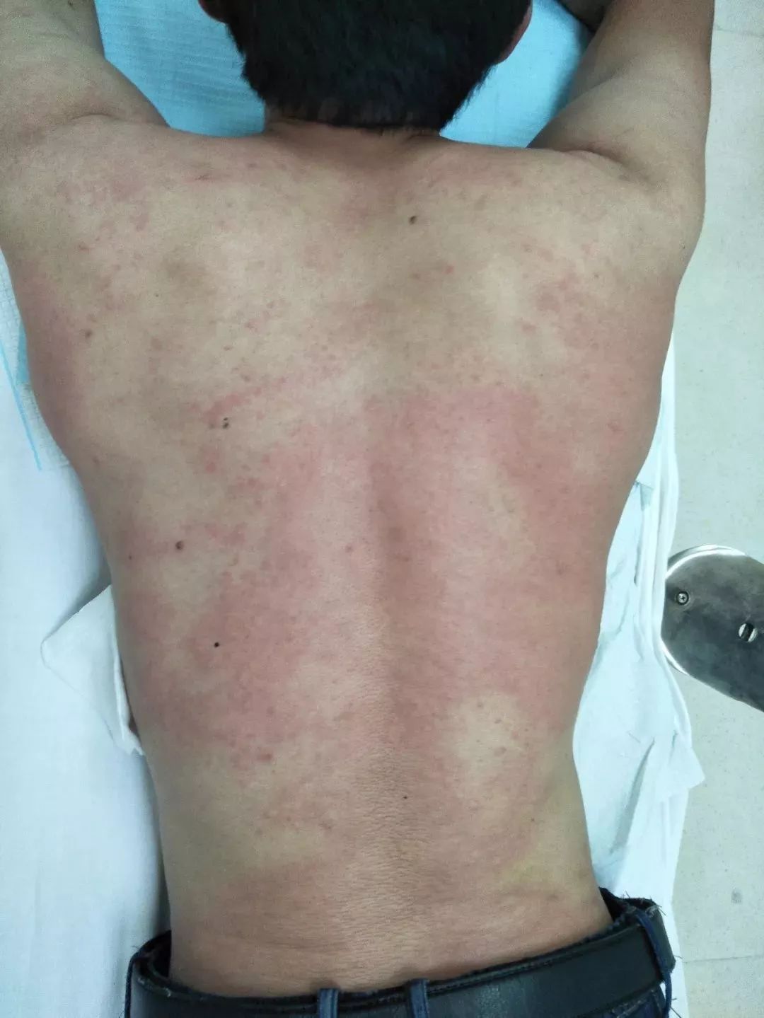 暑期出游注意！被蜜蜂蛰后，一死一生！这样做能救人一命！