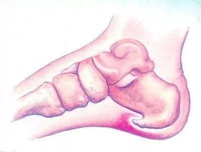 你还在“谈骨色变”吗？骨刺没你想的那么可怕