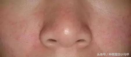 毛孔大和遗传有关系吗,脸出油有没有遗传关系