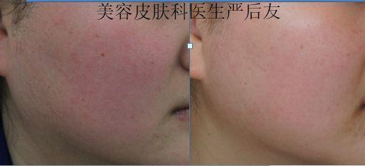 敏感性皮肤用什么化妆品好,敏感性皮肤的特征是什么