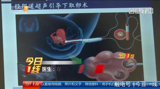 14岁少女被骗卖卵85万一条龙包成功