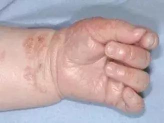 六个月宝宝湿疹皮肤破溃,宝宝起红疹破皮水泡