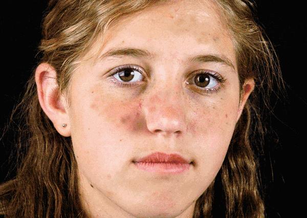 一分钟自测斑型,如何辨别自己属于哪类斑