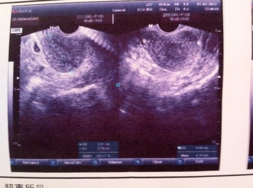 多囊卵巢综合症的症状能治好吗,多囊卵巢有什么症状及治疗方法