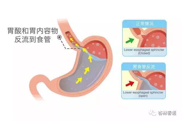 胃烧心反酸该怎么问诊,烧心反酸胸骨疼打嗝嗳气中医理论