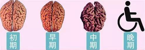 小脑萎缩的中医治疗与调养之道,老人小脑萎缩的症状与治疗方法