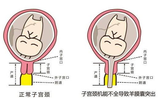 宫颈环扎的孕妈妈们,宫颈机能不全保胎的宝妈