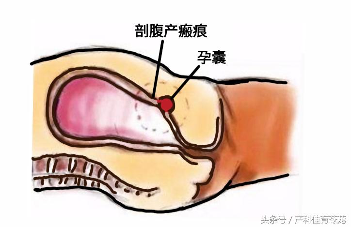 剖宫产横向瘢痕妊娠概率,怀孕7周异位妊娠瘢痕子宫