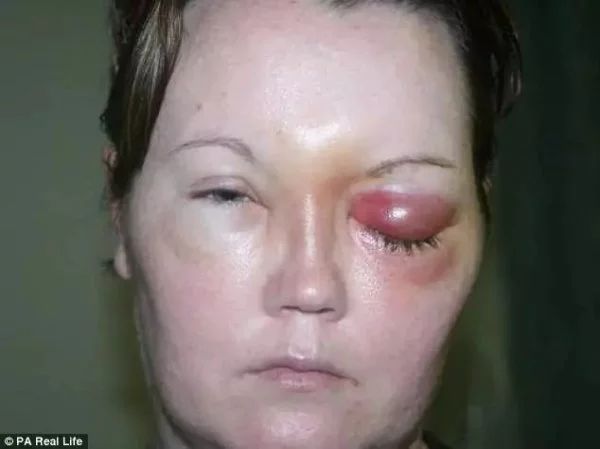 感染食脑虫的人,感染食脑虫的动物