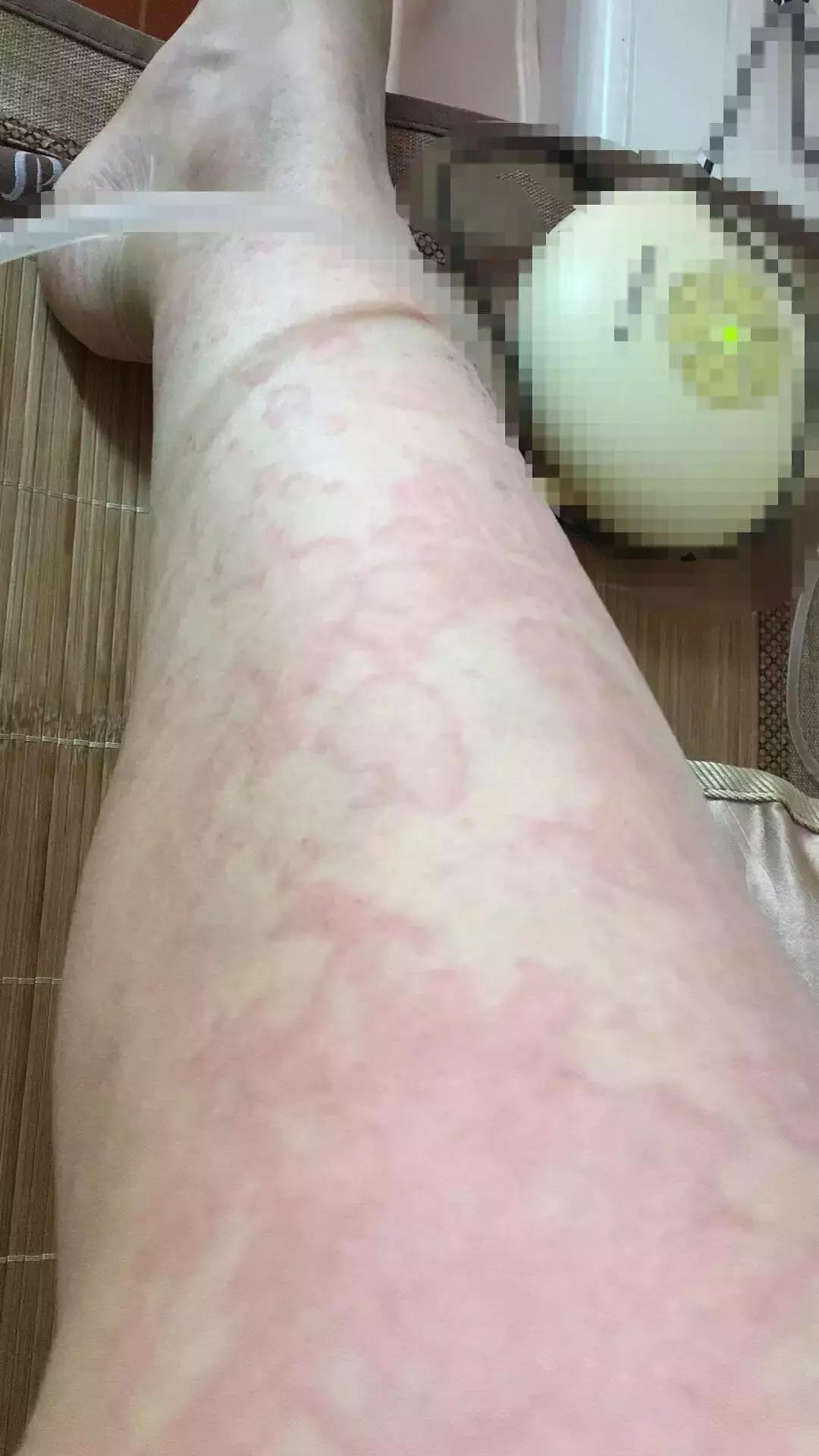 麻疹和荨麻疹的区别在哪,得了麻疹该怎么治疗