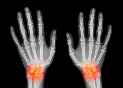 手麻要警惕病变,手麻肩膀痛警惕四种病