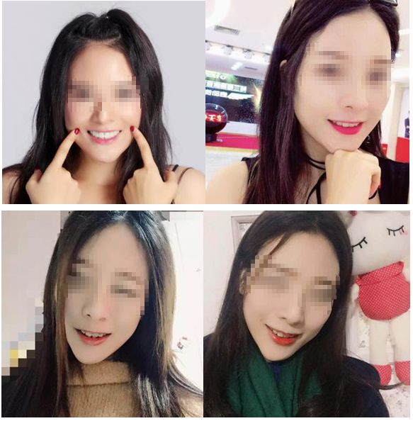 牙齿矫正8月最新价格,2024年30岁牙齿矫正费用多少钱