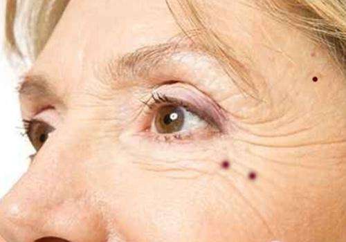 痣发红寓意,痣发红发痒怎么回事