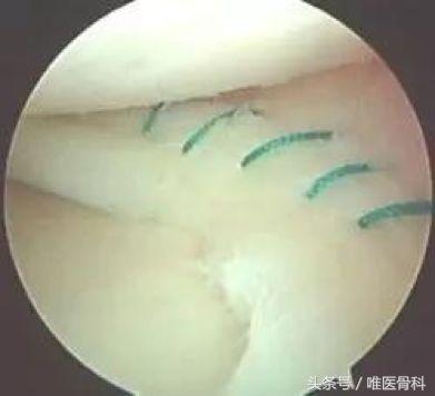 nba半月板损伤都是怎么恢复的,nba球星半月板损伤恢复比较好的