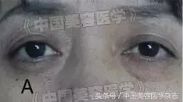 外眦悬吊固定视频操作方法,眼睑松弛矫正手术术前设计方案