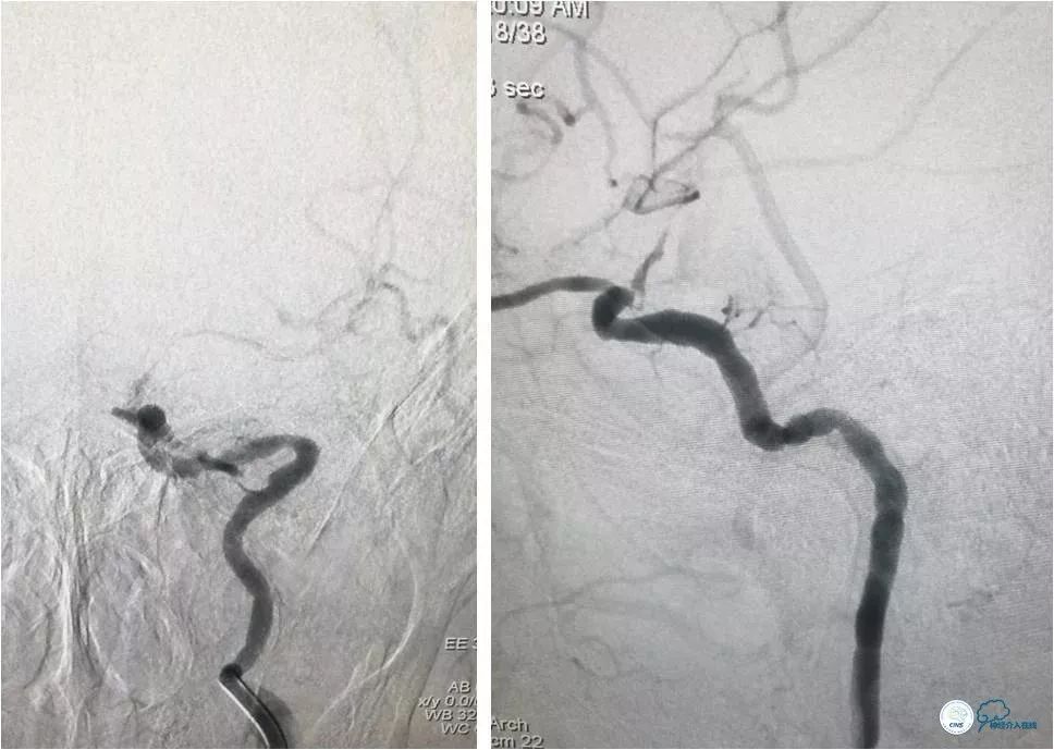 天坛医院住院日记,颈内动脉c5到c7段狭窄微创手术