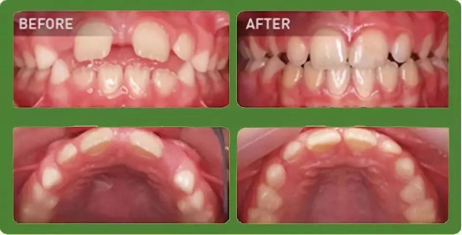 因为牙齿导致面容丑陋的孩子,小孩子牙齿漏风