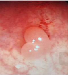 当内镜遇到情人节……