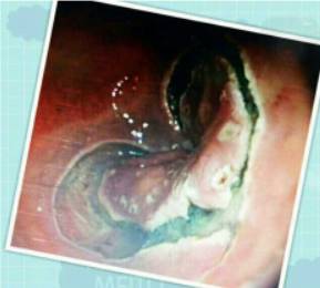 当内镜遇到情人节……