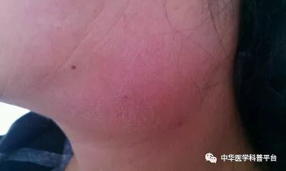 淋巴结肿大需要了解哪些内容,淋巴结你该了解的小知识