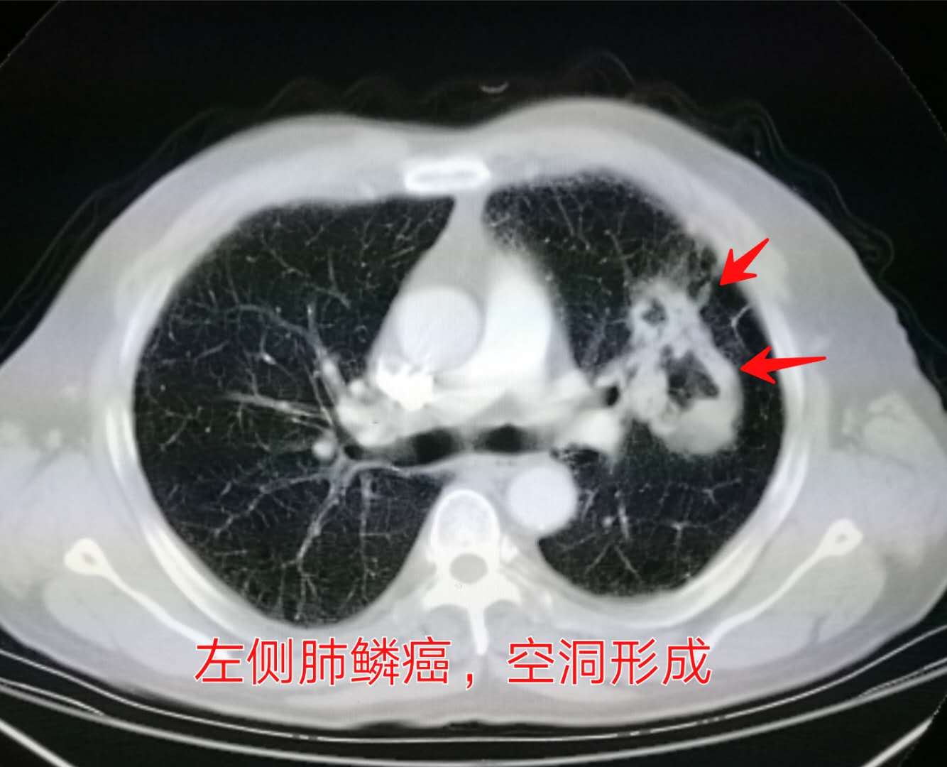 年轻人切除一个肾脏,切除一个肾脏手术全过程
