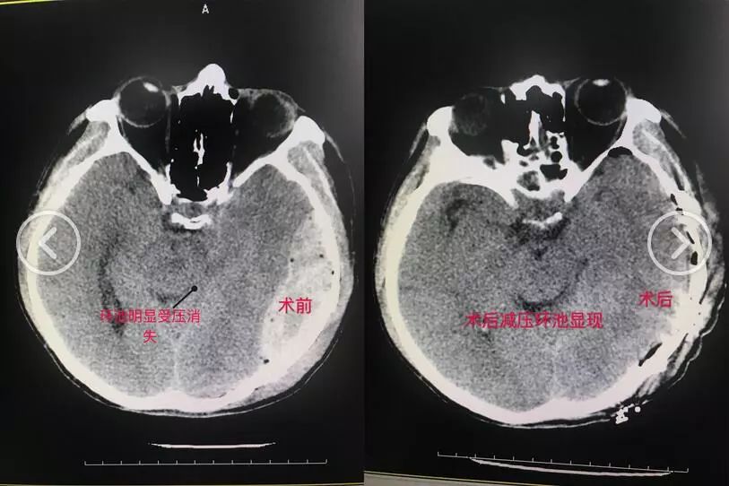「技术硬实力」不断创新发展的玉田县中医医院脑病四科！