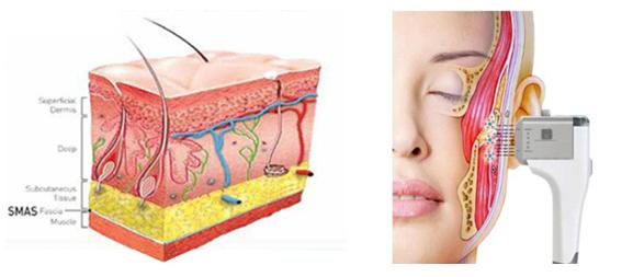 超声刀后注意什么,超声刀后什么不能吃