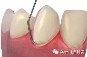 月子不刷牙用什么清洁牙齿,月子期间刷牙对牙齿有影响吗