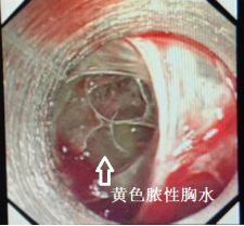 胸水抽了为什么还呼吸困难,胸水抽不出来了怎么回事