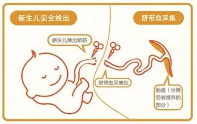 深圳首例干细胞治疗脑瘫,世界首例自体脐血移植