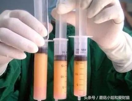 脸大面部凹陷的人好显老,脸上好多凹陷怎么回事