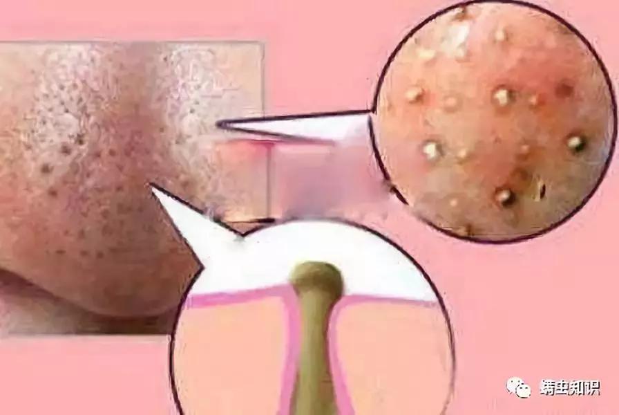 鼻子两侧黑头怎么处理,鼻子上有黑头应该注意些什么