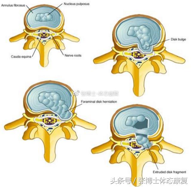 运动康复学治疗腰间盘突出,运动康复腰椎间盘突出
