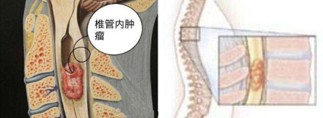 试遍了针灸艾灸拔罐，腰背疼痛的元凶竟是“肿瘤”