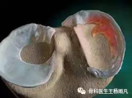 最新的人工膝关节使用寿命,膝关节使用说明