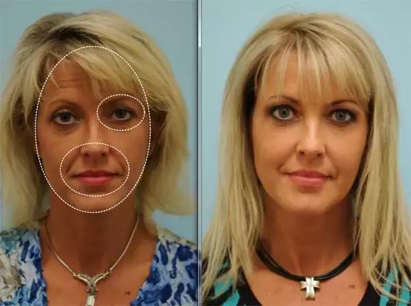 除了发量,最暴露年龄的可能是这两道纹