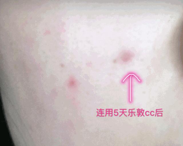 超好用的祛痘组合,祛痘产品测评排行榜