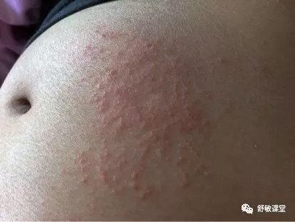 孕期湿疹长期用激素药膏有影响吗,孕妇脚湿疹擦什么药膏好