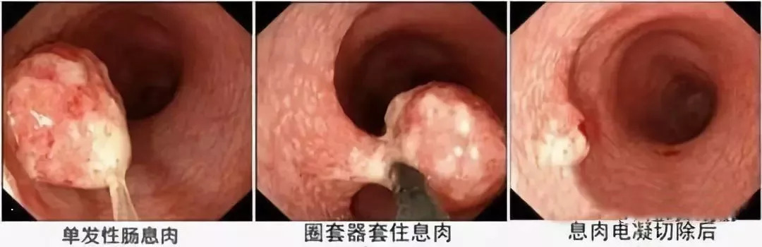 肠息肉是怎么引起的怎么治疗,肠息肉有什么办法阻止其生长