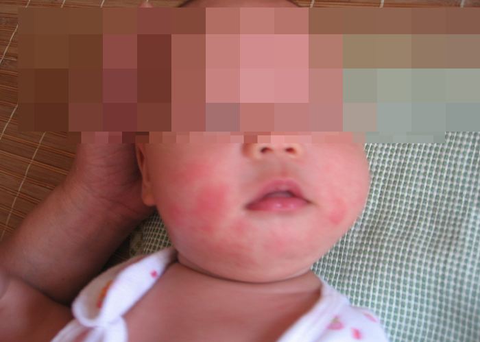 奶癣怎么快速消除小妙招,宝宝严重的奶癣怎么办