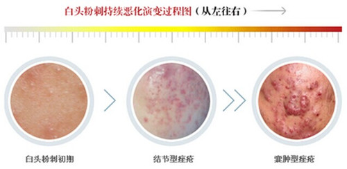 脸上的白头粉刺怎么去除简单方法,白头粉刺刺破变成红点