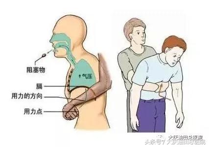 异物呛入气管的急救方法有哪三种,成人大蒜呛到鼻腔小妙招
