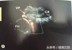 胎儿血管前置如何预防,孕妈课堂新生儿疾病筛查解读