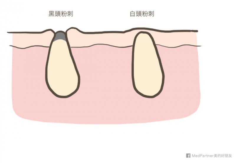 黑头贴吸出来的是粉刺还是黑头,去黑头闭口粉刺用黑头贴可以吗