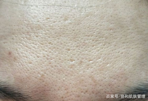 脸上的痘坑痘印怎么消除,脸上很多坑如何修复