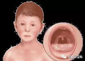 儿童急疹科普,宝宝湿疹和热疹的正确护理方法